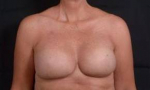 Immediate Breast Reconstruction - Skin Sparring - Case #3 After