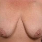 Immediate Breast Reconstruction - Skin Sparring - Case #9A Before