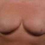 Immediate Breast Reconstruction - Skin Sparring - Case #9A After