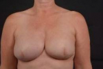 Immediate Breast Reconstruction - Skin Sparring - Case #8 After