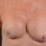 Immediate Breast Reconstruction - Skin Sparring - Case #7 Before