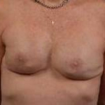 Immediate Breast Reconstruction - Skin Sparring - Case #7 After