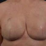 Immediate Breast Reconstruction - Skin Sparring - Case #6 After