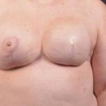Immediate Breast Reconstruction - Skin Sparing - Case #2 After