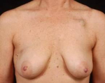 Immediate Breast Reconstruction - Skin Sparing - Case #1 Before