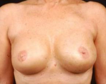 Immediate Breast Reconstruction - Skin Sparing - Case #1 After