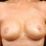 Immediate Breast Reconstruction - Skin Sparing - Case #1 After