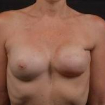 Reconstructive Breast Revision - Case #28 Before