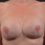 Reconstructive Breast Revision - Case #25 After
