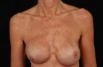 Reconstructive Breast Revision - Case #20 Before
