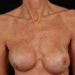 Reconstructive Breast Revision - Case #20 Before