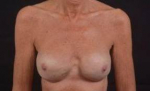 Reconstructive Breast Revision - Case #20 After