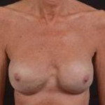 Reconstructive Breast Revision - Case #20 After