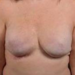 Reconstructive Breast Revision - Case #30 Before