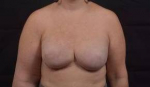 Reconstructive Breast Revision - Case #30 After