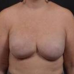 Reconstructive Breast Revision - Case #30 After