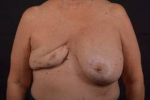 Reconstructive Breast Revision - Case #22 Before