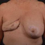 Reconstructive Breast Revision - Case #22 Before