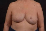 Reconstructive Breast Revision - Case #22 After