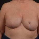 Reconstructive Breast Revision - Case #22 After