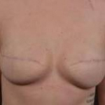Breast Reconstruction Revision - Case #21 Before