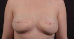 Breast Reconstruction Revision - Case #21 After