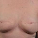 Breast Reconstruction Revision - Case #21 After