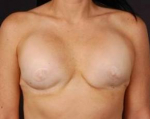 Reconstructive Breast Revision - Case #1 Before