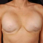 Reconstructive Breast Revision - Case #1 Before
