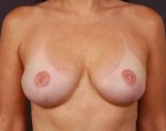 Reconstructive Breast Revision - Case #1 After