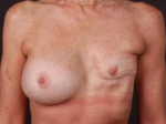 Reconstructive Breast Revision - Case #2A Before