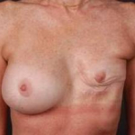 Reconstructive Breast Revision - Case #2A Before