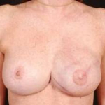 Reconstructive Breast Revision - Case #2A After