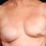 Reconstructive Breast Revision - Case #3 Before