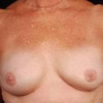Reconstructive Breast Revision - Case #3 After