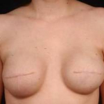 Reconstructive Breast Revision - Case #4 Before
