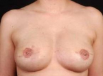 Reconstructive Breast Revision - Case #4 After