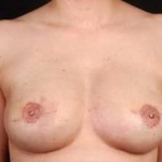 Reconstructive Breast Revision - Case #4 After