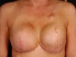 Reconstructive Breast Revision - Case #5 Before
