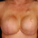 Reconstructive Breast Revision - Case #5 Before