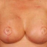 Reconstructive Breast Revision - Case #5 After