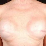 Reconstructive Breast Revision - Case #6 Before