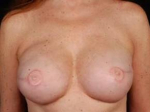 Reconstructive Breast Revision - Case #6 After