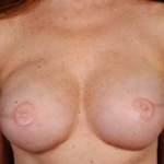 Reconstructive Breast Revision - Case #6 After