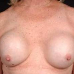 Reconstructive Breast Revision - Case #7 Before