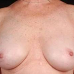 Reconstructive Breast Revision - Case #7 After