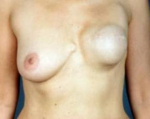 Reconstructive Breast Revision - Case #8 Before