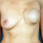 Reconstructive Breast Revision - Case #8 Before