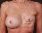 Reconstructive Breast Revision - Case #9 Before