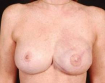 Reconstructive Breast Revision - Case #9 After